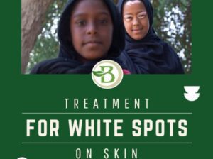 A Comprehensive Guide to Vitiligo and Homeopathic Treatment Options