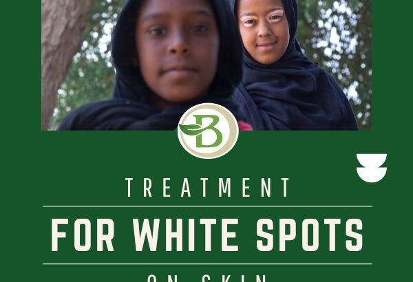 A Comprehensive Guide to Vitiligo and Homeopathic Treatment Options